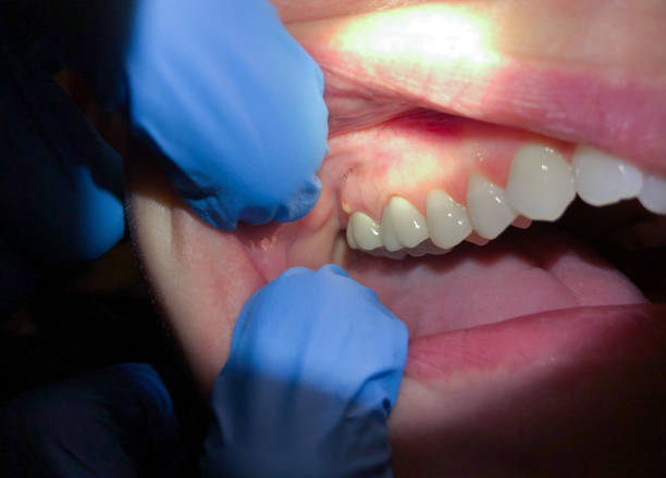 Best Emergency Dental Care for Broken or Chipped Teeth in South Patrick Shores, FL