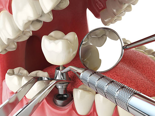 Best Emergency Treatment for Dental Infections or Abscesses in South Patrick Shores, FL